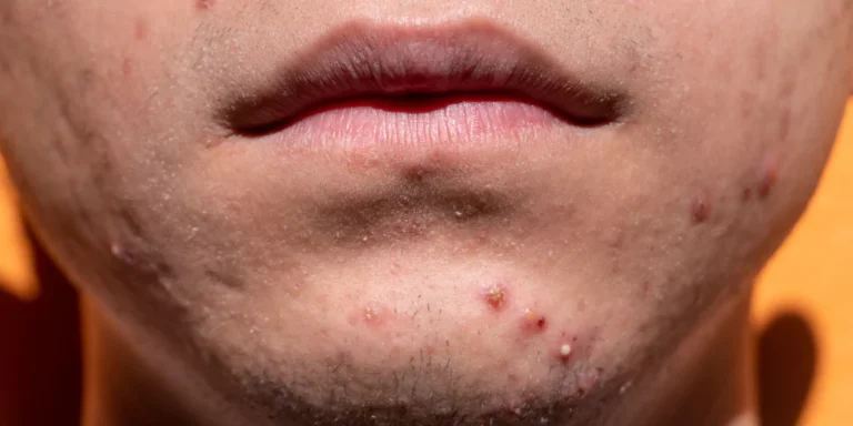 ছেলেদের মুখে ব্রণ দূর করার উপায়